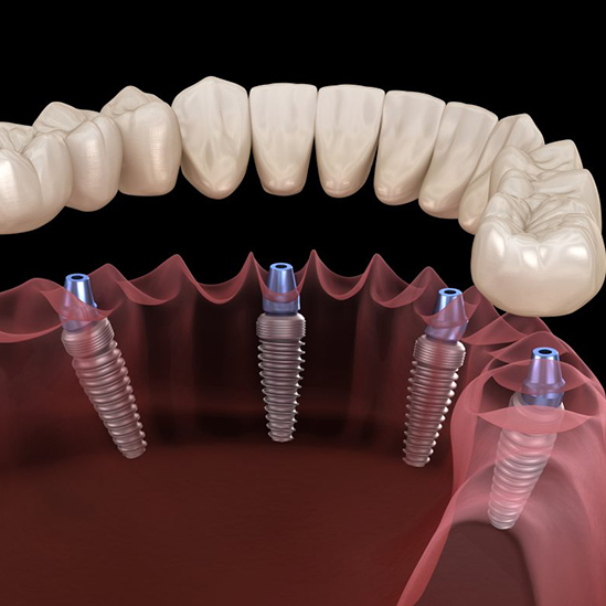 all-on-4-dental-implants-barrie